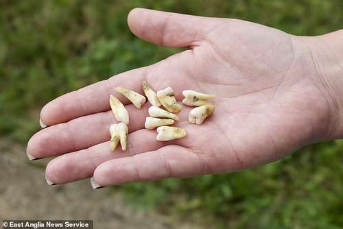 Ms Watts was taking painkillers daily due to the 'constant pain' and despite looking for a new NHS dental practice for six years, she was forced to pull out her own teeth (Pictured)