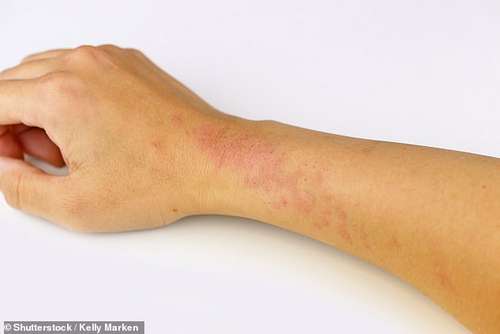 Keeping warm in winter may lower the risk of eczema symptoms, suggest doctors at Shanghai Dermatology Hospital in China