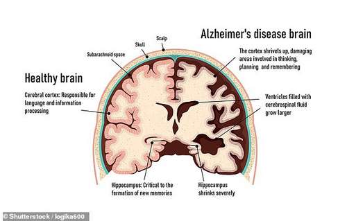 Alzheimer's disease is characterized by an accumulation of abnormal neuritic plaques and neurofibrillary tangles. This causes a gradual decline in memory, thinking, behavior and social skills