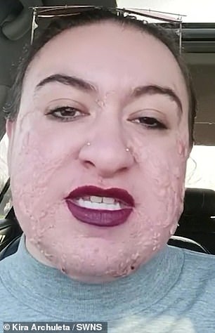 She is pictured above speaking about the condition on her TikTok channel