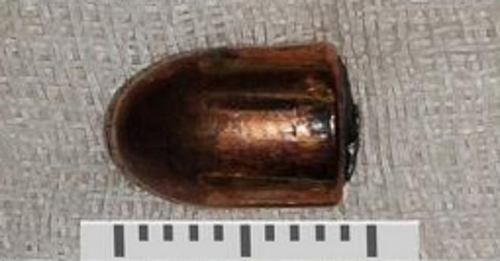 The bullet doctors removed measured 9mm x 18 mm