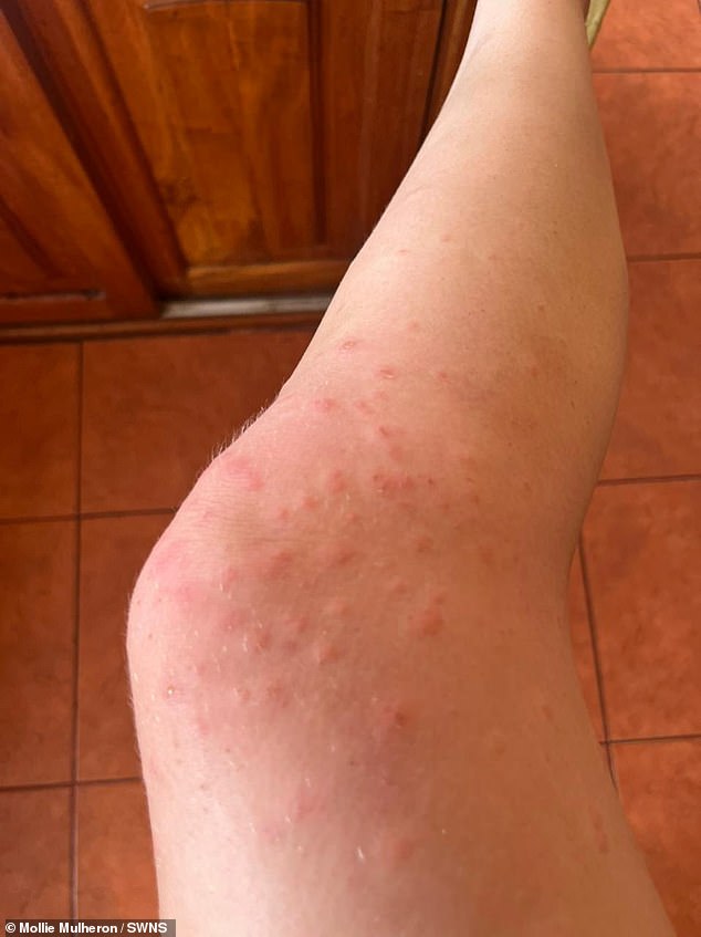 Despite having such difficulty breathing that she almost drowned while snorkelling, doctors told her the issues were 'in her head' and that she was 'too stressed' (Pictured is a rash she developed while traveling, one of her cancer symptoms)