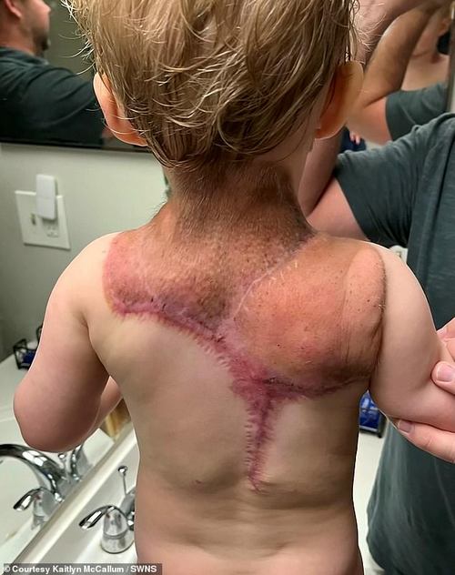 He has undergone two major surgeries to have the growth removed. Doctors are now using expanders to encourage his skin to start replacing the nevus