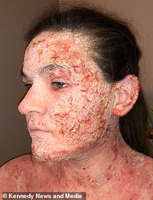Natalie's condition causes itching that can't be helped and leaves her with raw, bloody and oozing with open sores