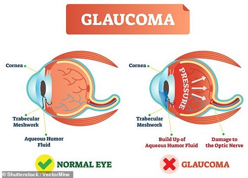 It's usually caused by fluid building up in the front part of the eye, which increases pressure inside the eye (stock image)