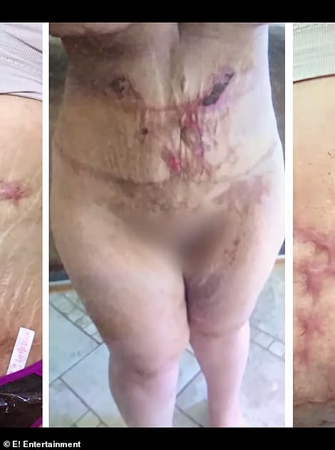 Ouch: Jessica wanted 'bigger breasts' and more skin removed, so she went to Tijuana to have another round of surgeries. The surgeon applied surgical tape directly onto her wounds