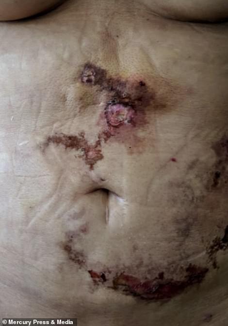 Sivan's infected stomach is pictured. She said: 'I thought that surgery can improve the areas I was insecure about - that it would boost up my confidence and give me the courage to finally live life to the fullest.