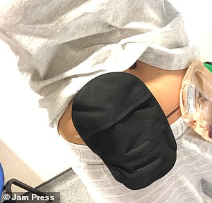 Despite already undergoing surgery in 2018, Ms Bailey's bowel was then removed the following year during a 'routine check'. She did not state why doctors performed this procedure. But endometrium tissue can grow on the surface or inside the intestines, rectum or other parts of the bowel. Surgery is usually required to remove the affected section of the bowel