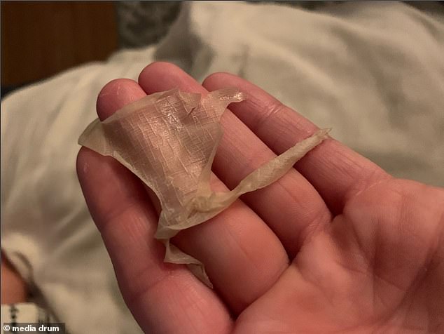 At times, the pain has been so unbearable, that Ms Stout has had to open blisters into wounds herself in order to stop the pain and start the healing process