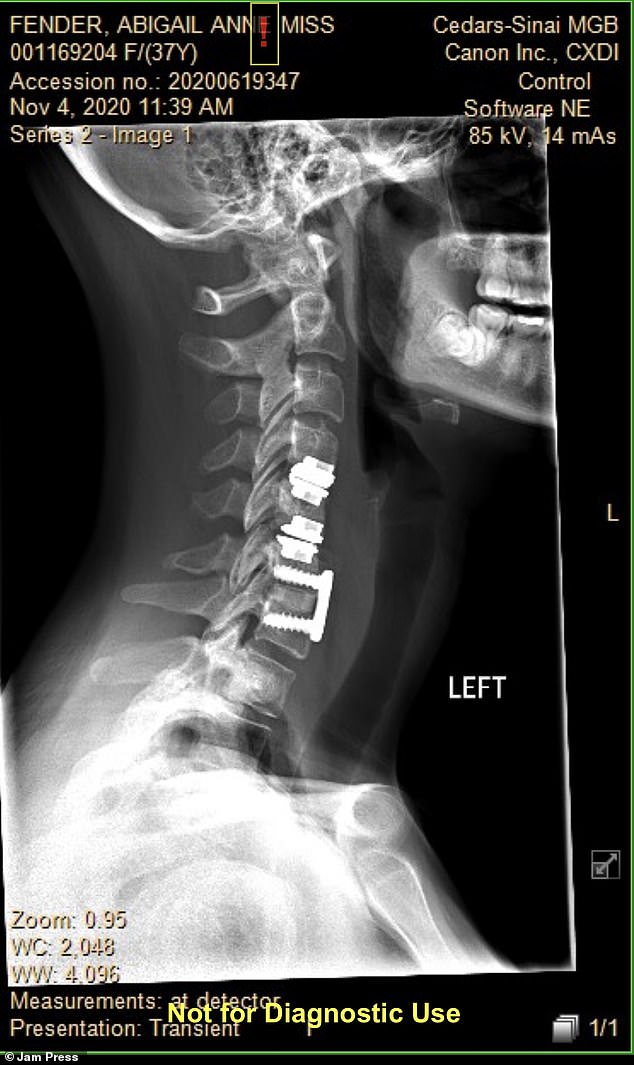 Post-surgery, Ms Fender was shocked to discover her vocals were 'paralysed' and her Texas accent had disappeared