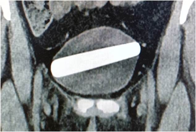 Woman, needs dildo surgically removed from her BLADDER