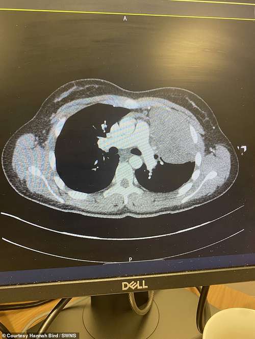 The doctors (above) gave Hannah an x-ray and a CT scan, on her return and the following day she was told she had cancer, on April Fool's Day 2022