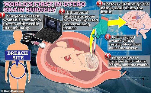 For in-utero surgery, doctors will be breached into the womb of the mother and operate on the unborn child. In the procedure conducted in Boston, scientists used an ultrasound to find nerves that would be affected by a rare one in 60,000 birth defect called vein of Galen malformation. Children born with this condition have a 30 percent chance of dying by age 11. In this case, the surgery was successful and the child was born days later with no heart or brain issues