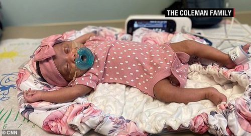 Denver (pictured) was healthy upon birth and is still doing well two months later. Doctors are excited about the surgeries potential