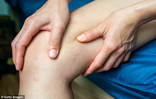 How can I get rid of my unsightly varicose veins?