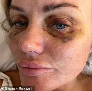 AFTER her nose job
