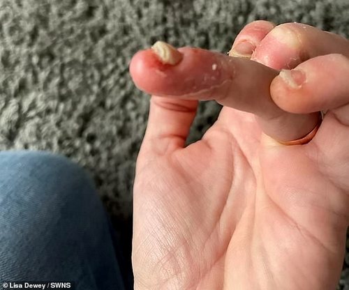 Now Mrs Dewey has vowed to stay away from nail products for good — and is warning others about the risks. Pictured: Mrs Dewey's nails after her reaction