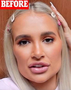 Molly-Mae Hague pictured in 2019 having had filler added to various parts of her face