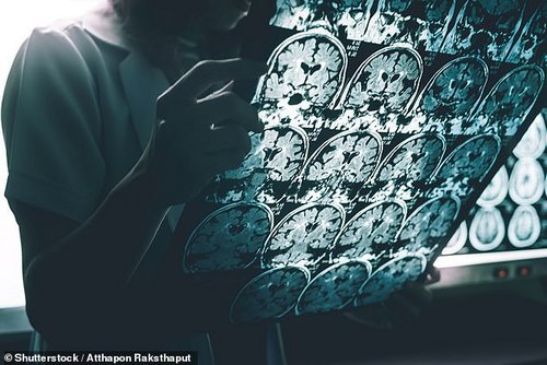 A toxic proteins called amyloid have been heavily linked to Alzheimer's over the past few decades, with neurologists believing they may cause the disease. The new drug&nbsp;donanemab is designed to flag the protein to the body's immune system