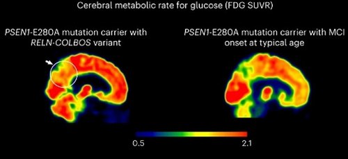 The team found that the man had a mutation in a gene coding for a protein called reelin, which is associated with brain disorders, including schizophrenia and autism