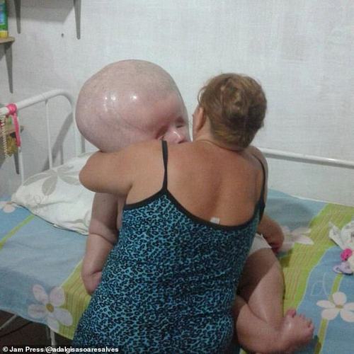 While already larger than normal when she was born her head is now three times the size of a normal person's