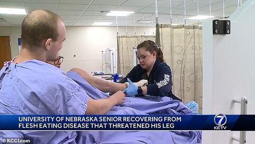 He is shown above having cream rubbed onto his wounded leg, where the necrotizing fasciitis emerged